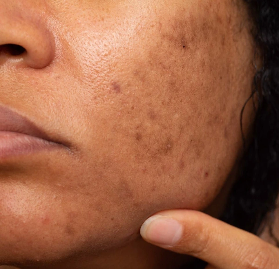 pigmentation