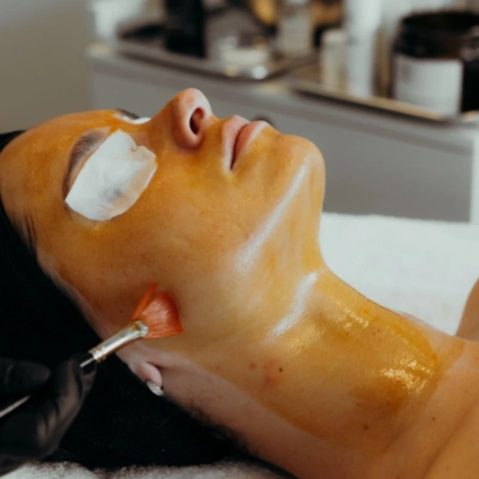 chemical peel