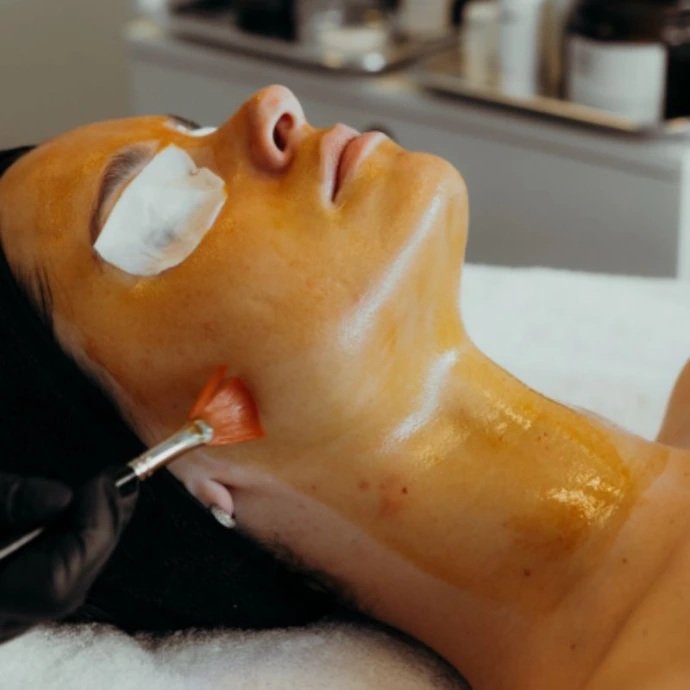 chemical peel