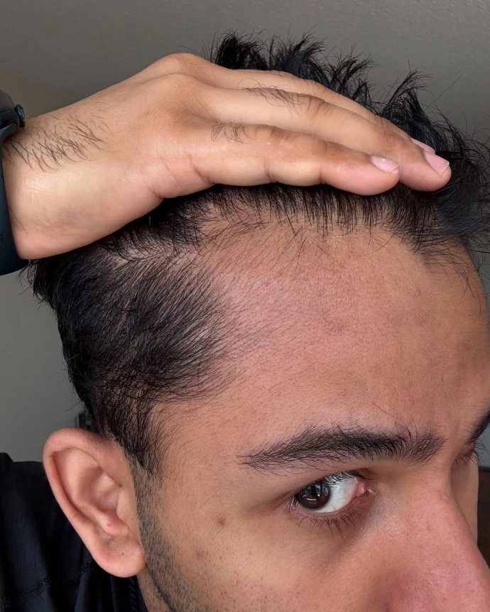 hair regrowth